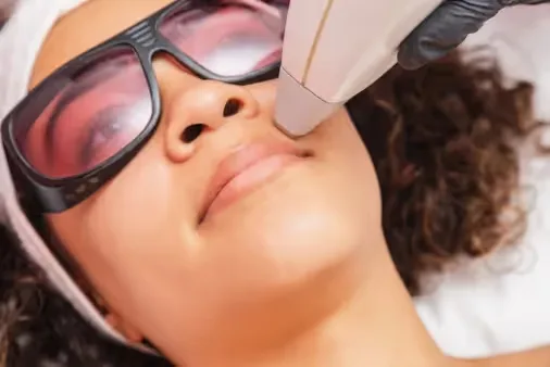 A dermatologist performs laser hair removal on the upper lips