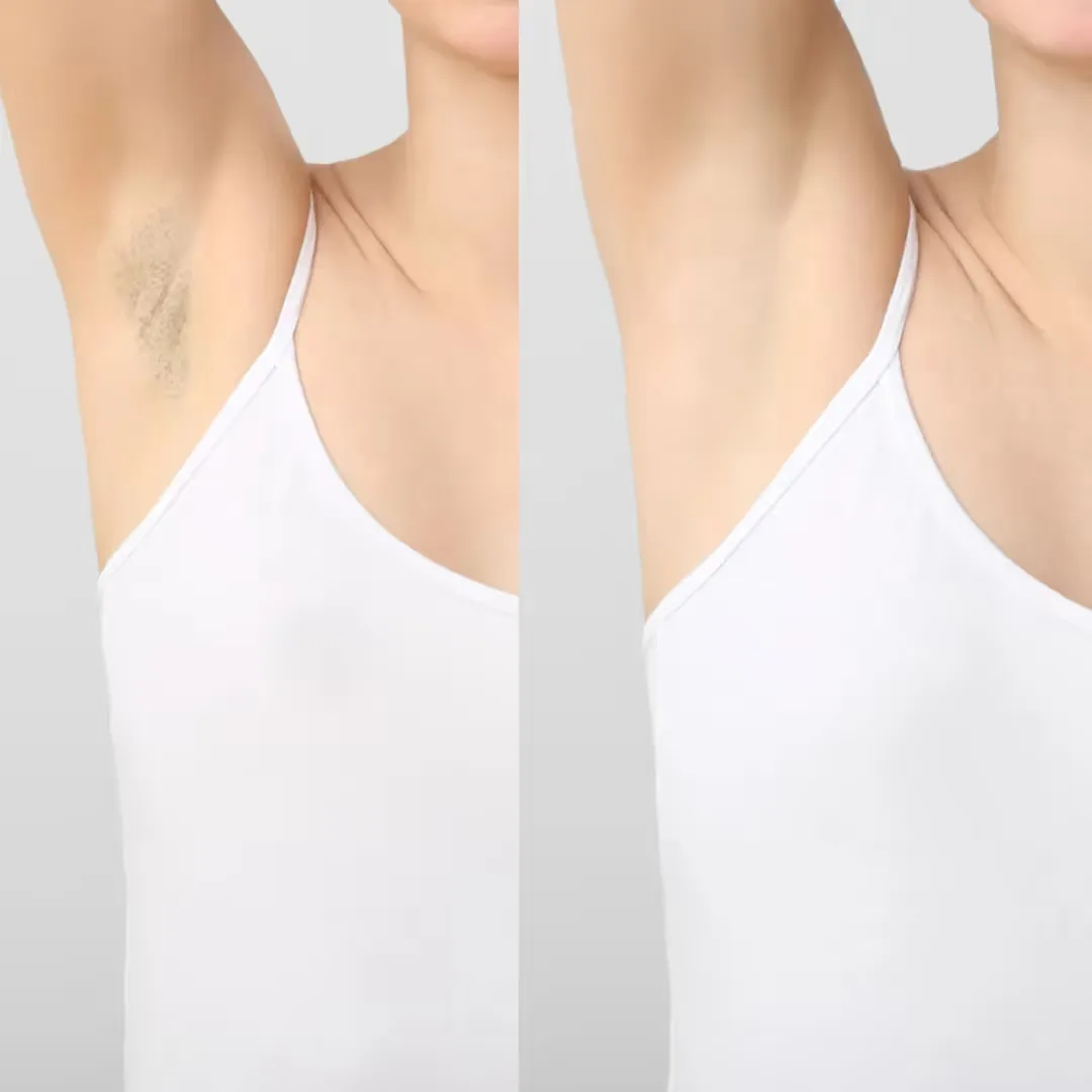 Laser Hair Removal treatment before and after results image