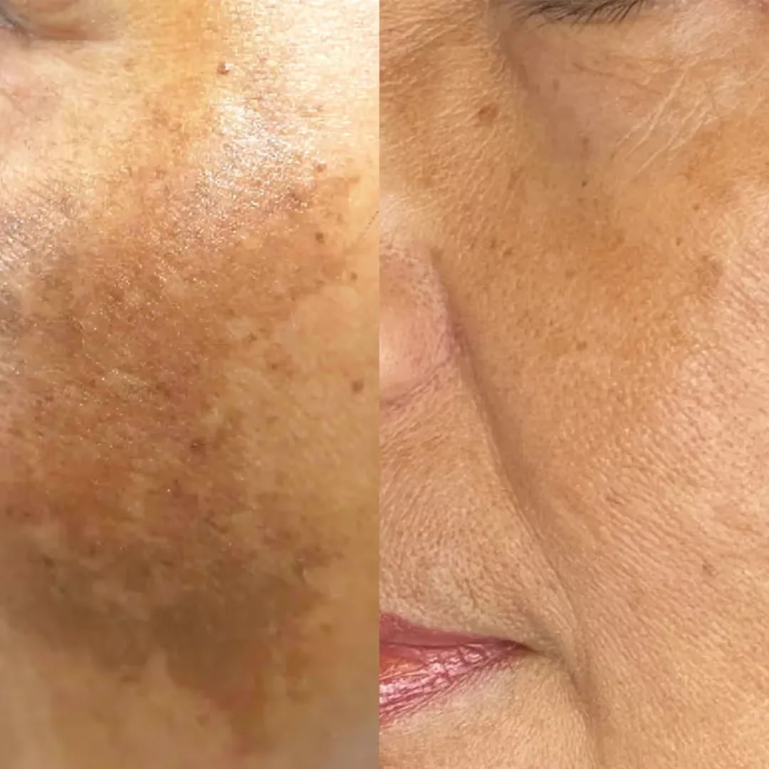 Laser toning treatment results in women's cheeks