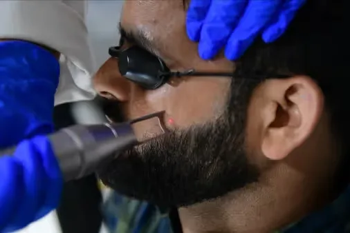 Laser Toning treatment performed on men's face