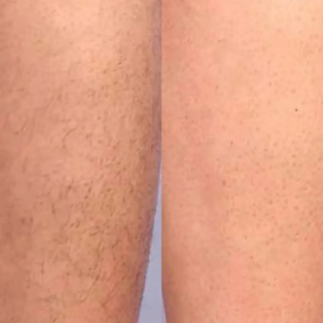 What is the cost of laser hair removal in Gurgaon and Delhi NCR?