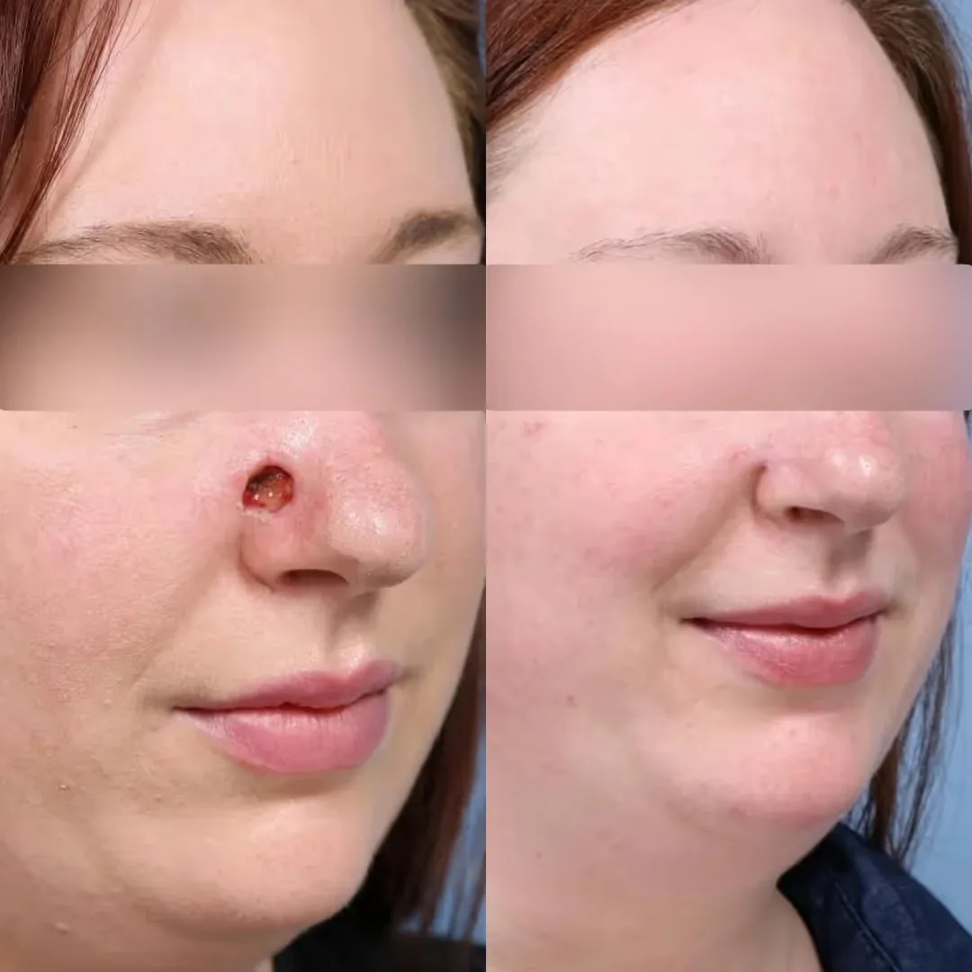 Before and after Lesion Treatment image