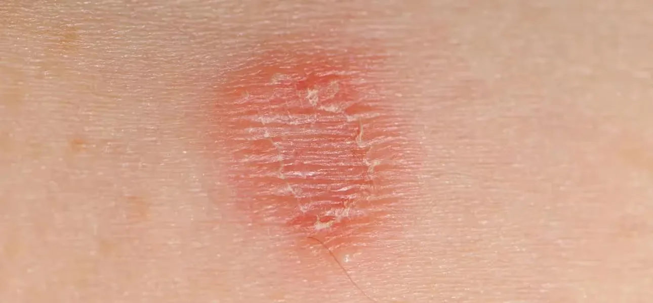 lesion treatment at Uncover Clinics