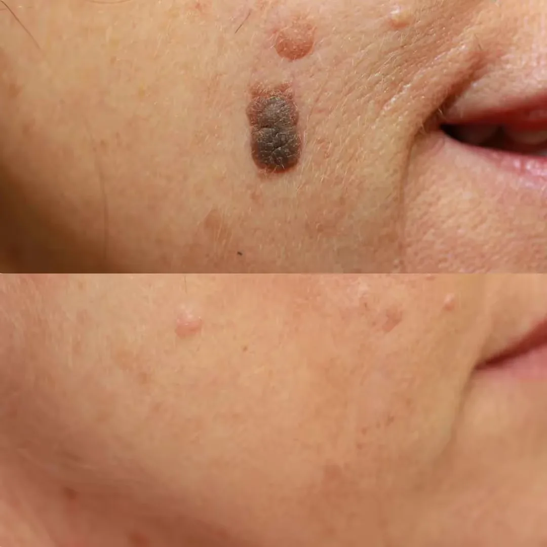Lesion Treatment performed by an expert dermatologist