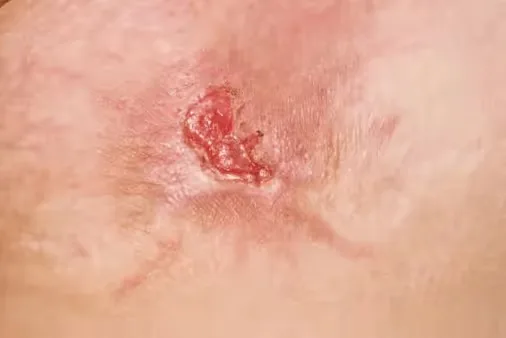 Cost of Kenacort Lesion Treatment