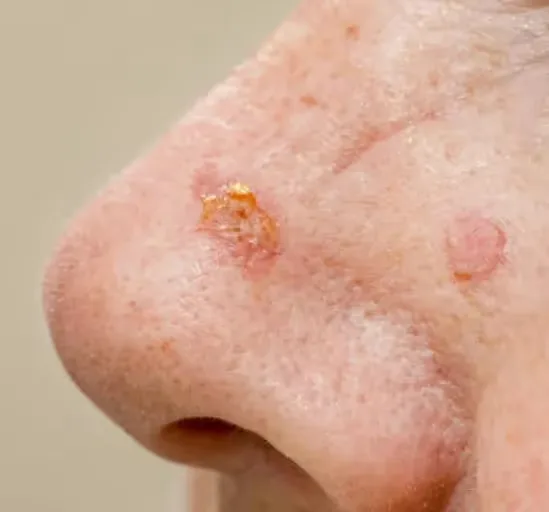 Skin Lesions Treatment at Uncover