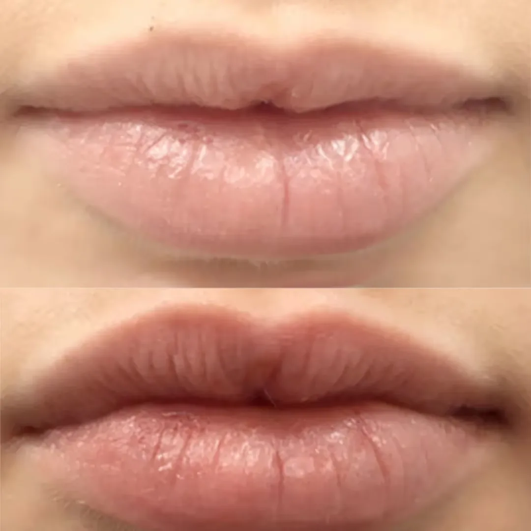 Before and after Hydrafacial Lip Perk