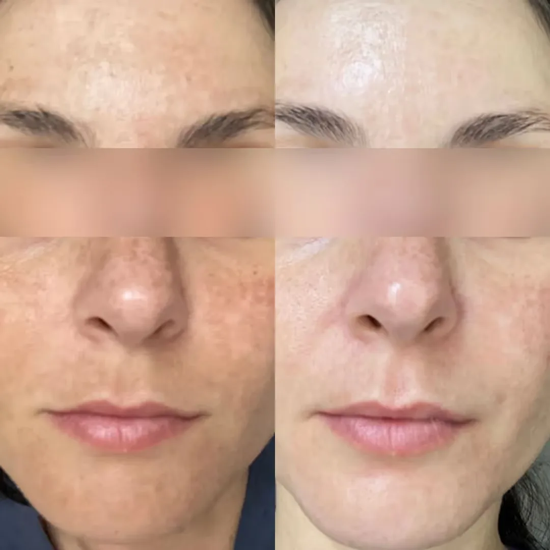 Medi-facials before and after result image