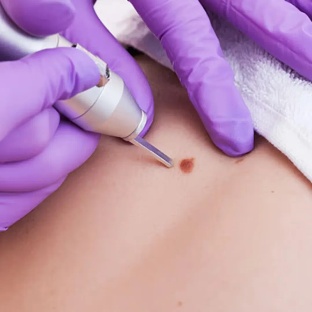 A Dermatologists performs Mole Removal treatment