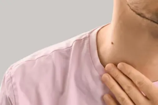 The image shows mole on the neck