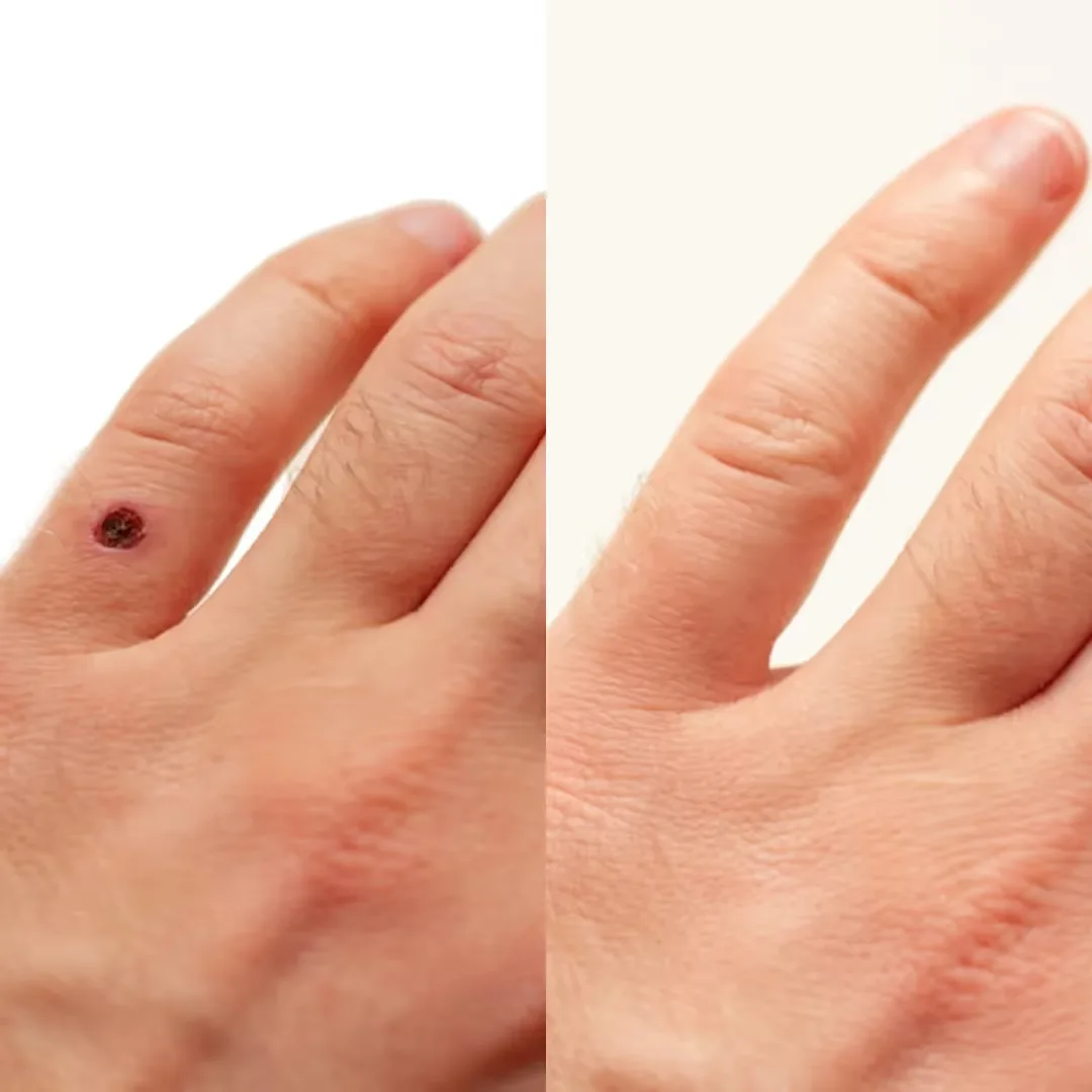 Cost of Mole Removal at UNCOVER Clinics