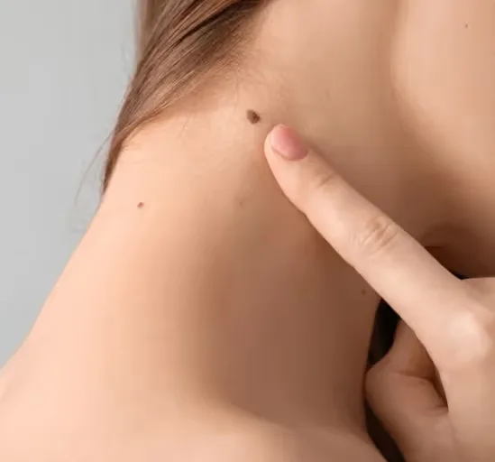 Erase Moles, Enhance Your Beauty at Uncover Clinics