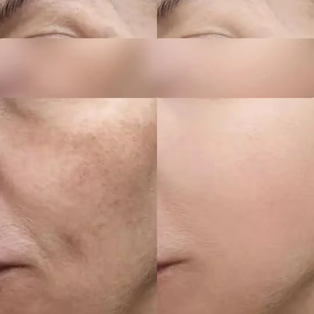 Before and after Morpheus8 MNRF treatment