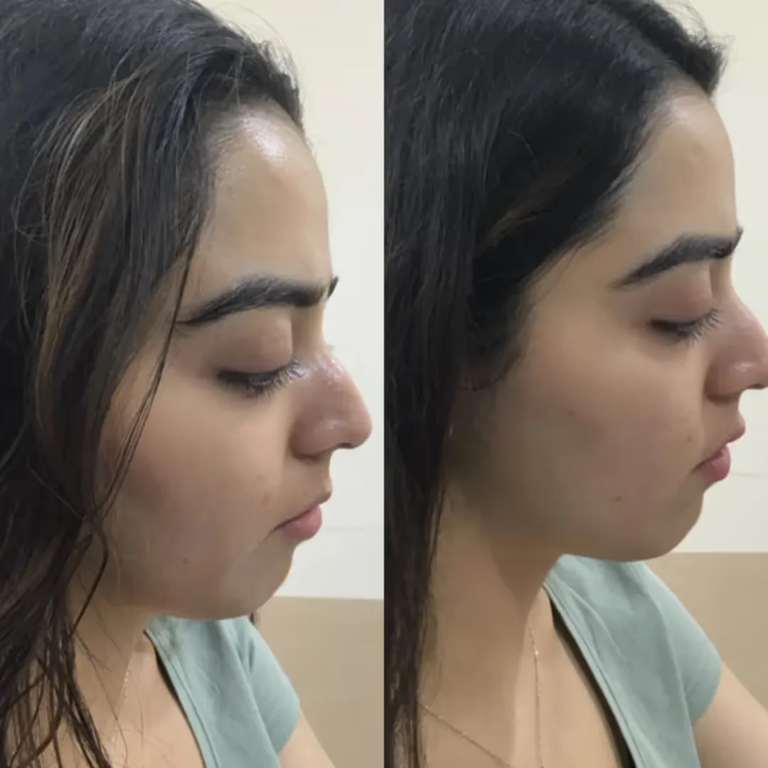 OxyBright Facial treatment before and after the result images