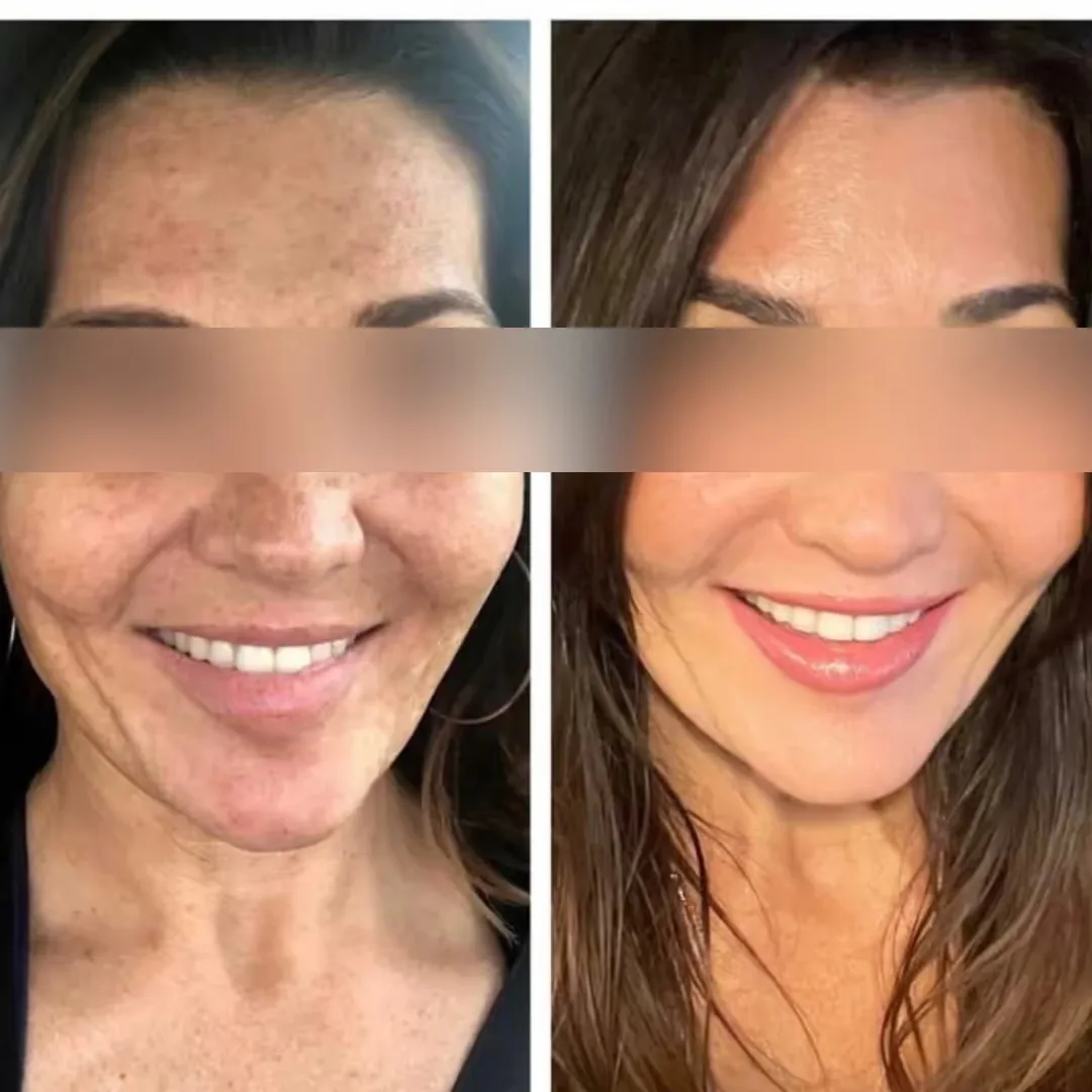Before and After the Party Peel treatment image