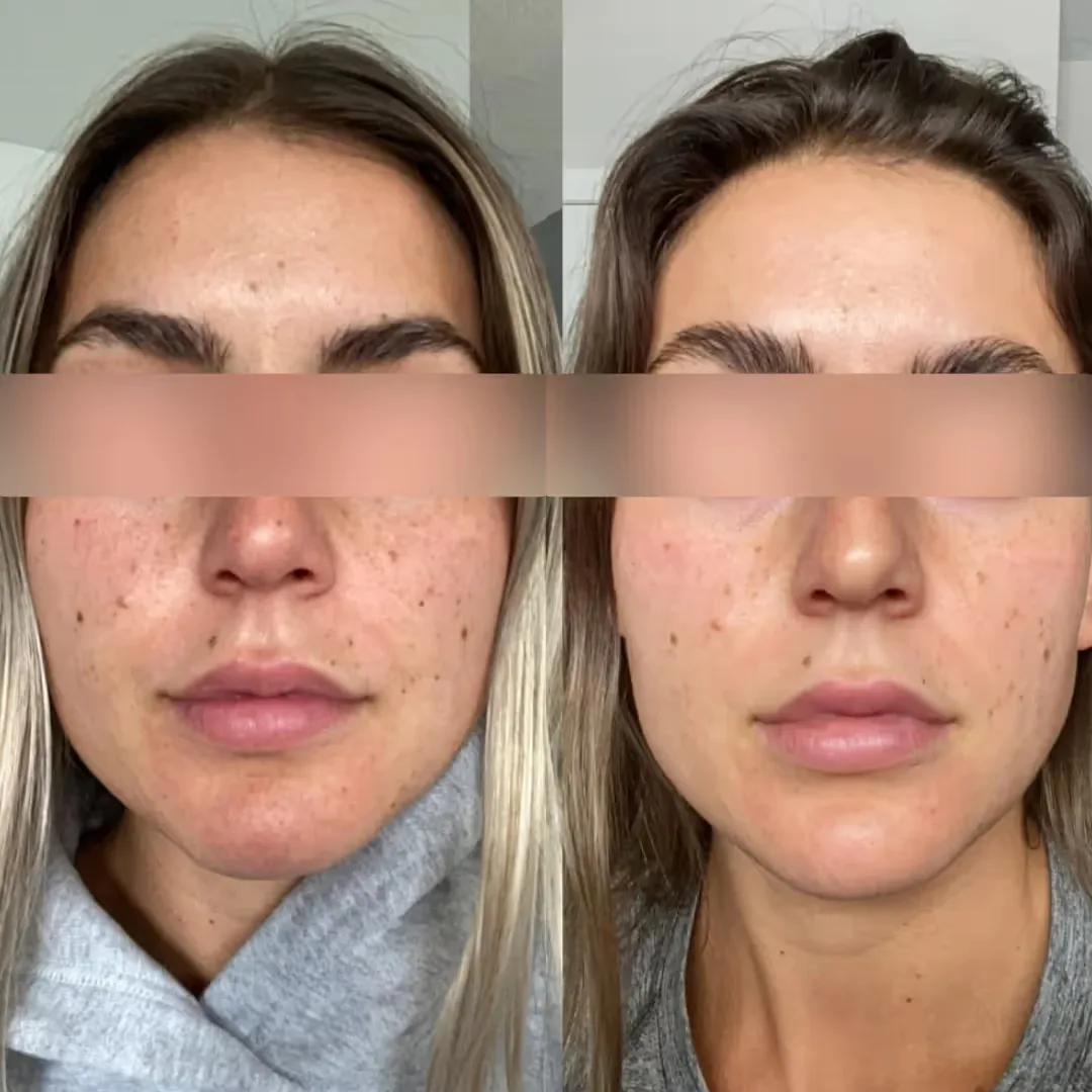 Before and After Photo Facials treatment