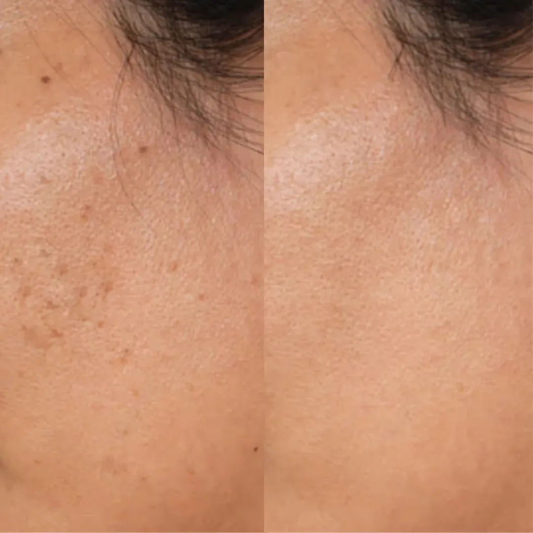 Before and after result image of UnTint Pigment Buster Peel