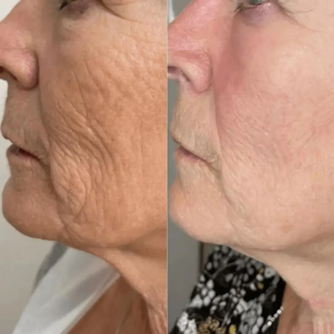 Profhilo Skin Boosters performed on women decrease wrinkles