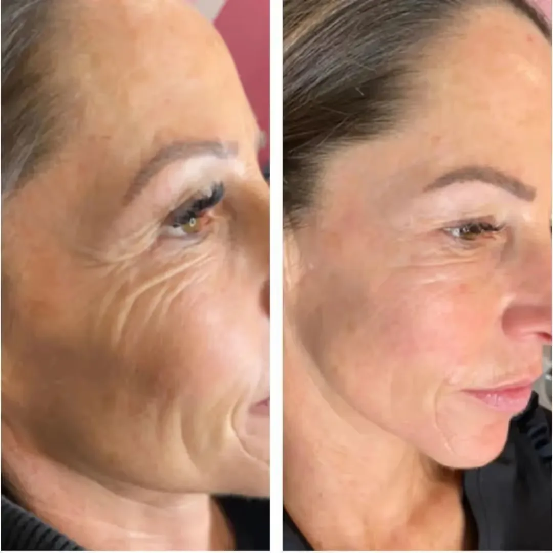 Profhilo Skin Boosters before and after results image