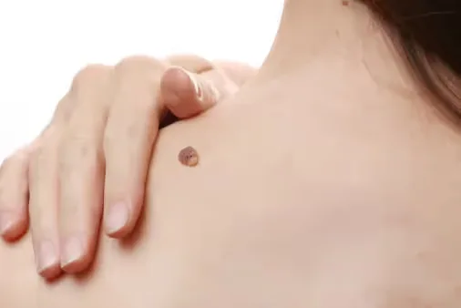 The image shows skin tags on the back of a girl
