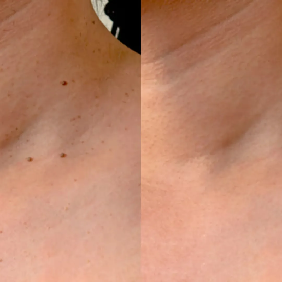 Before and after Skin Tag Removal treatment