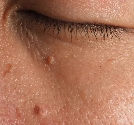 Expert Skin Tag Removal at Uncover Clinics