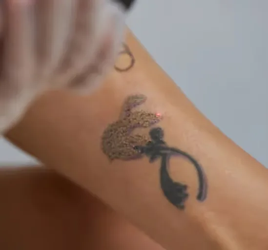An expert dermatologist performs Tattoo Removal treatment
