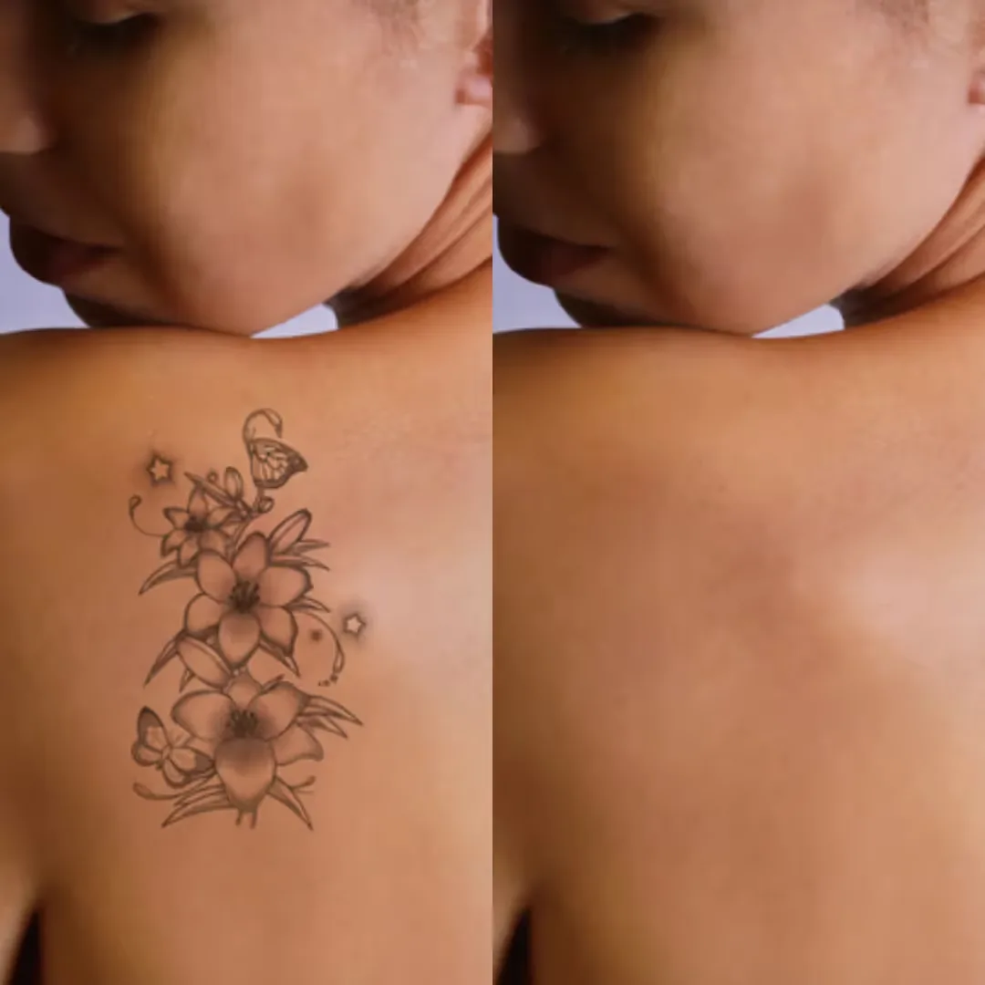 Before and after Tattoo Removal treatment at Uncover
