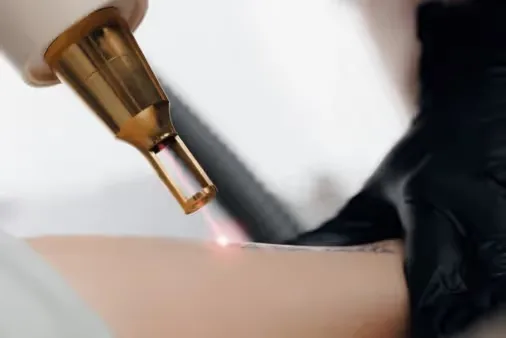 A dermatologist performs Tattoo Removal treatment at Uncover