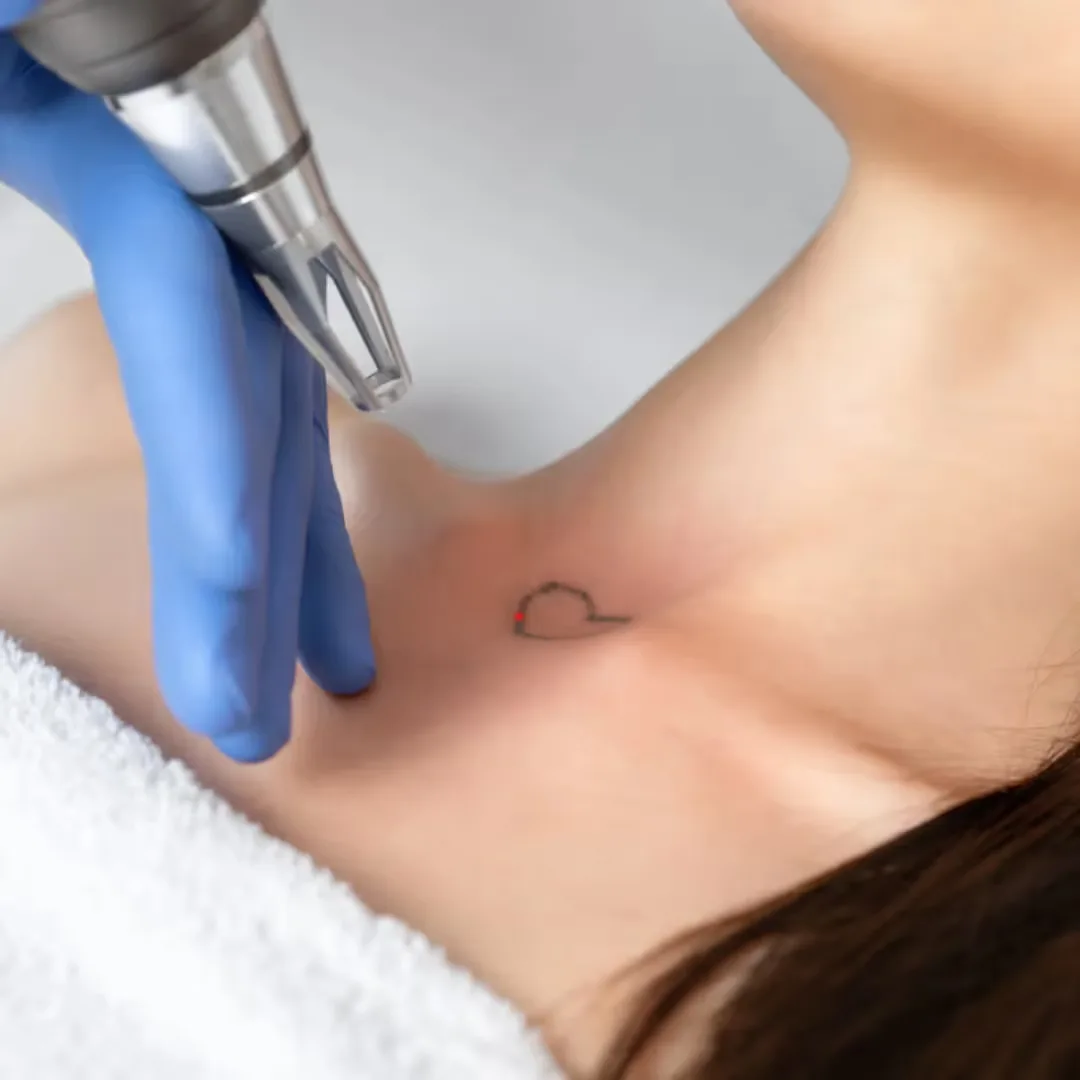 Process and technology for tattoo removal