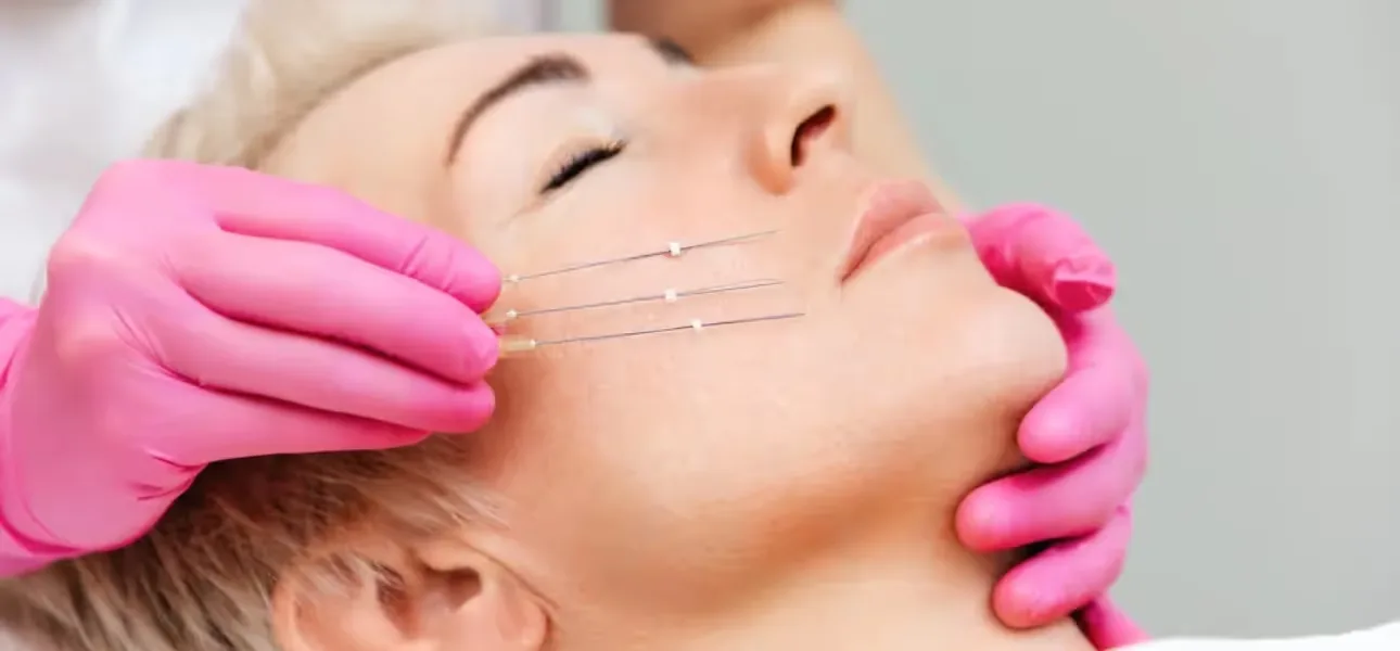An expert dermatologist performs Thread Lift treatment