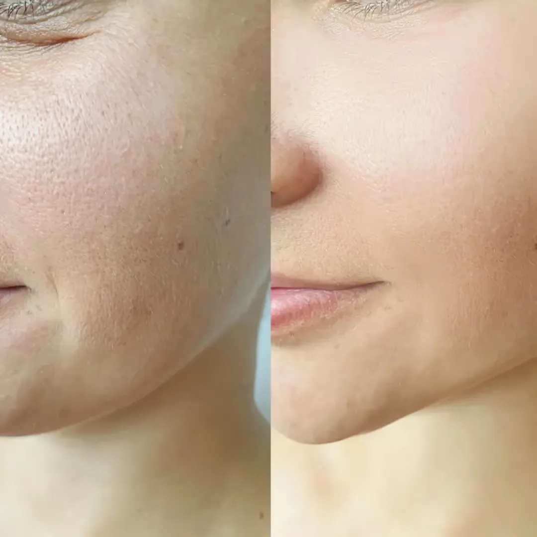 Before and after Thread Lift Treatment image