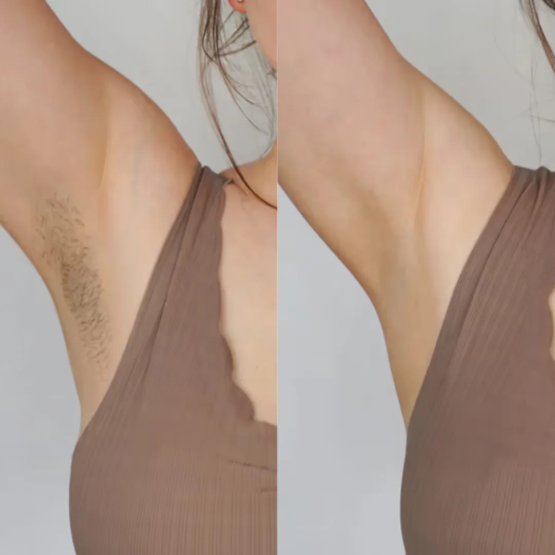 Before and after Underarms Laser Hair Removal treatment results image