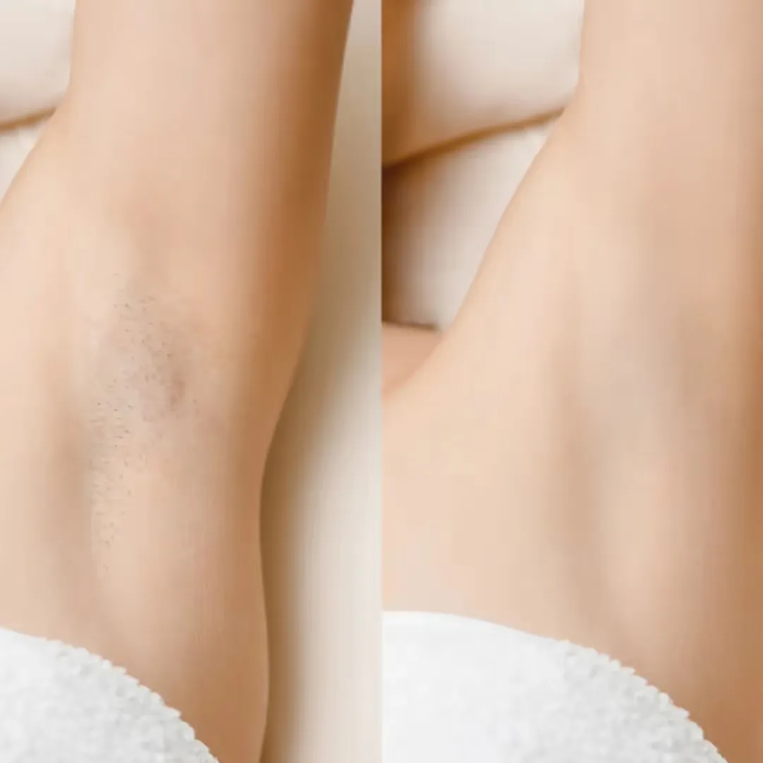 Underarm Pigment Buster treatment before and after image