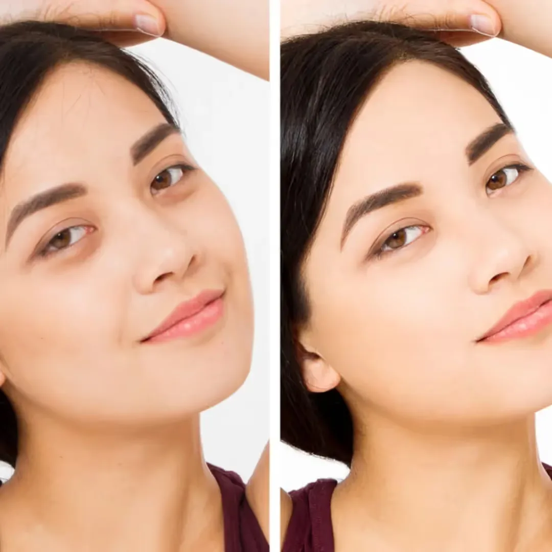 Before and after Under Eye Peel results