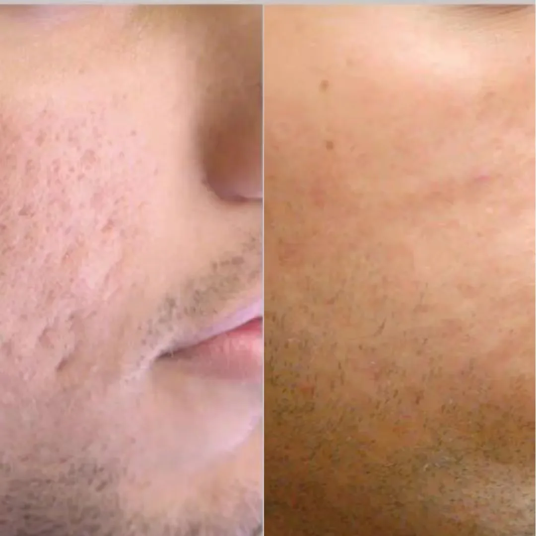 Why Uncover Clinics for Vampire Facial?