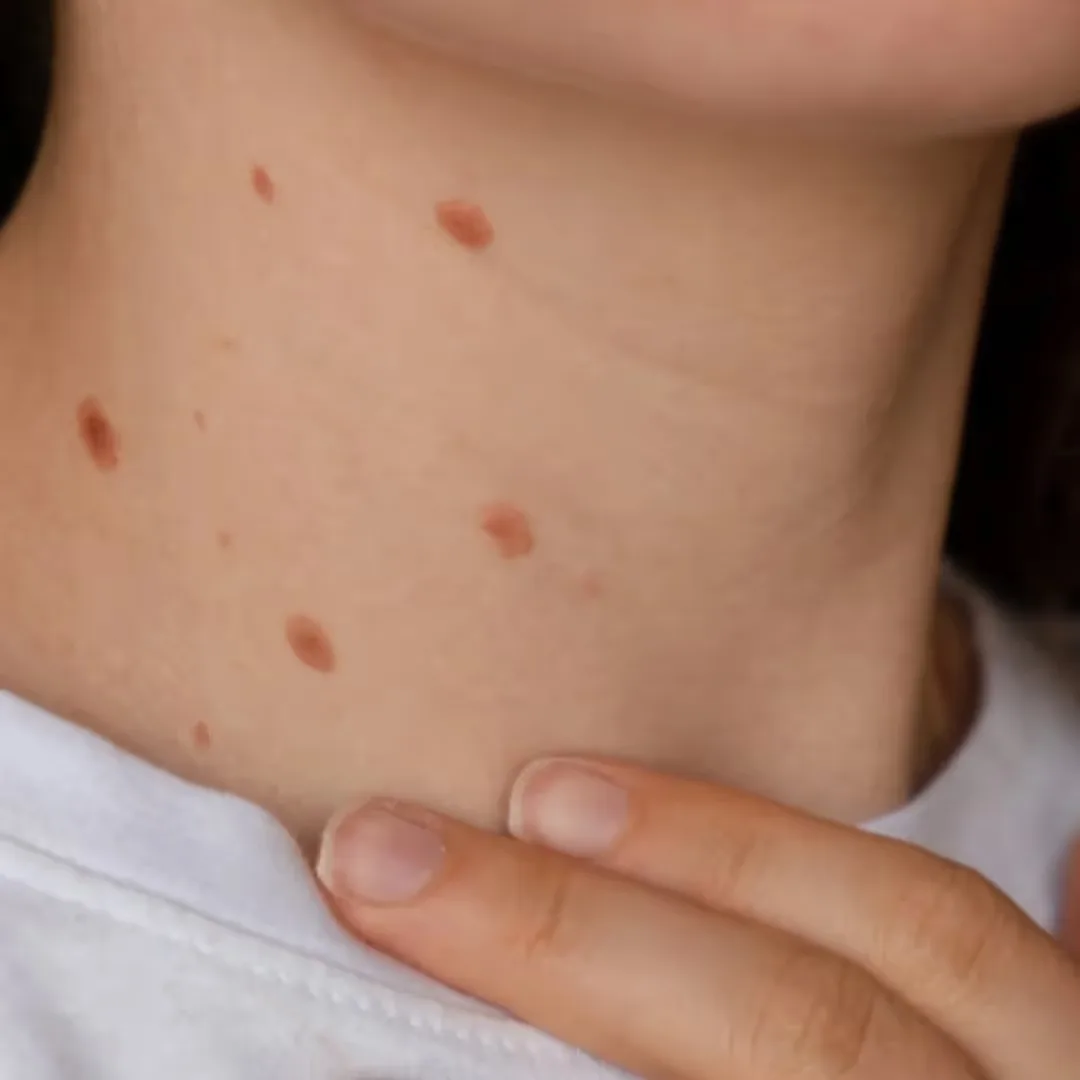 The image shows Wart on the neck