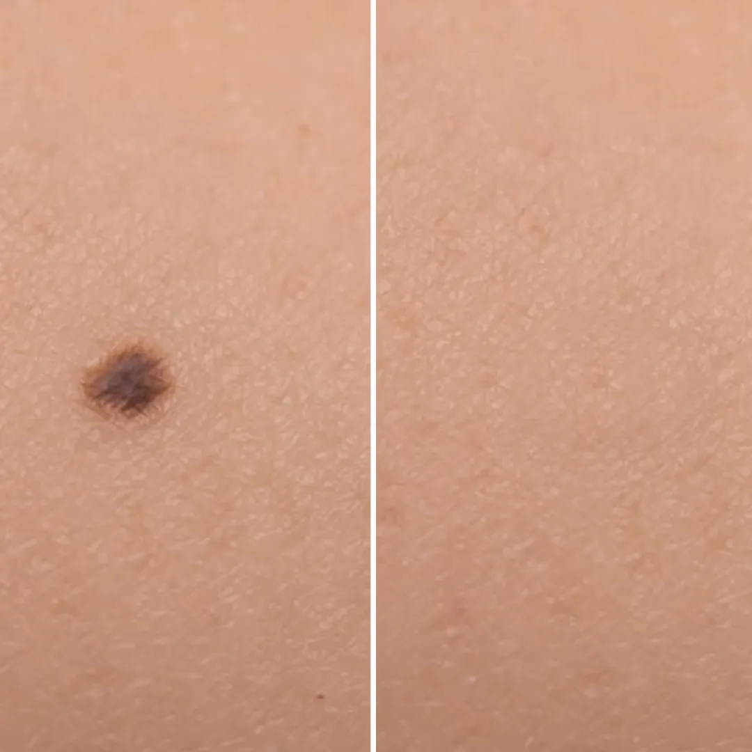 Before and after Wart Removal treatment in Uncover