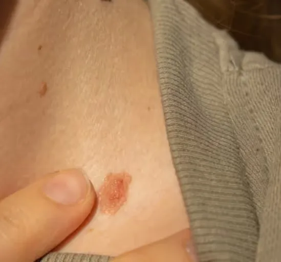 Starts with Expert Wart Removal at Uncover Clinics