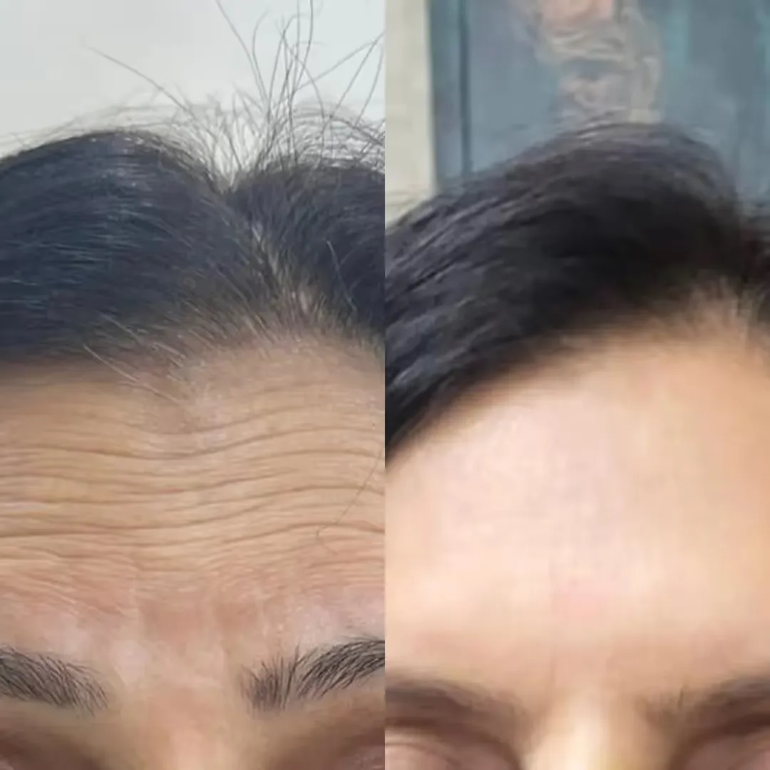 Before and after Wrinkle relaxer therapy performed by a dermatologist results