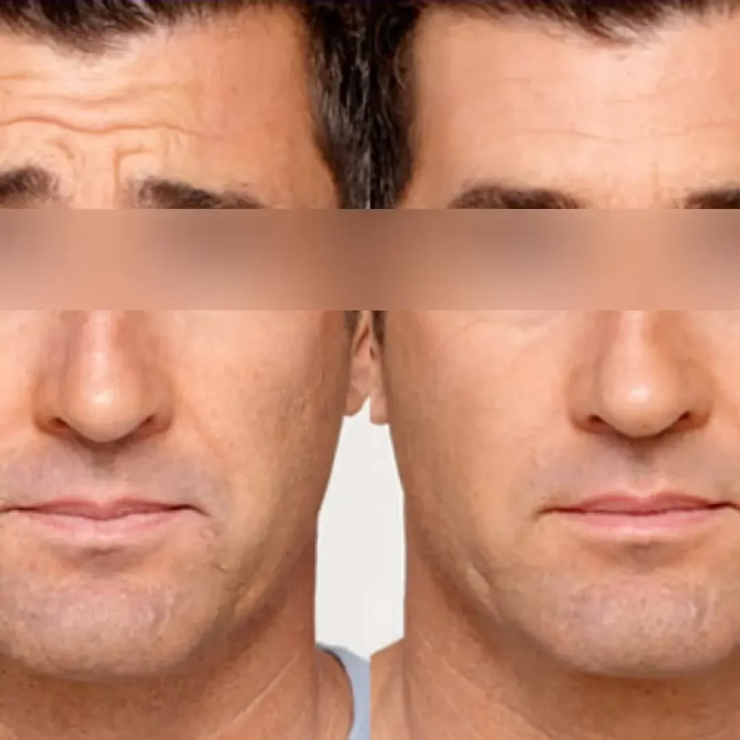 Cost of Wrinkle Relaxers