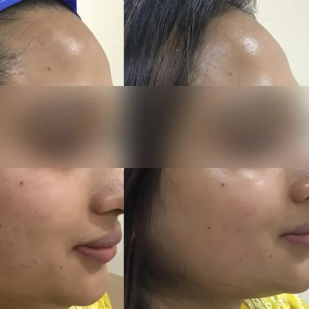 Zo Obagi Facial before and after results