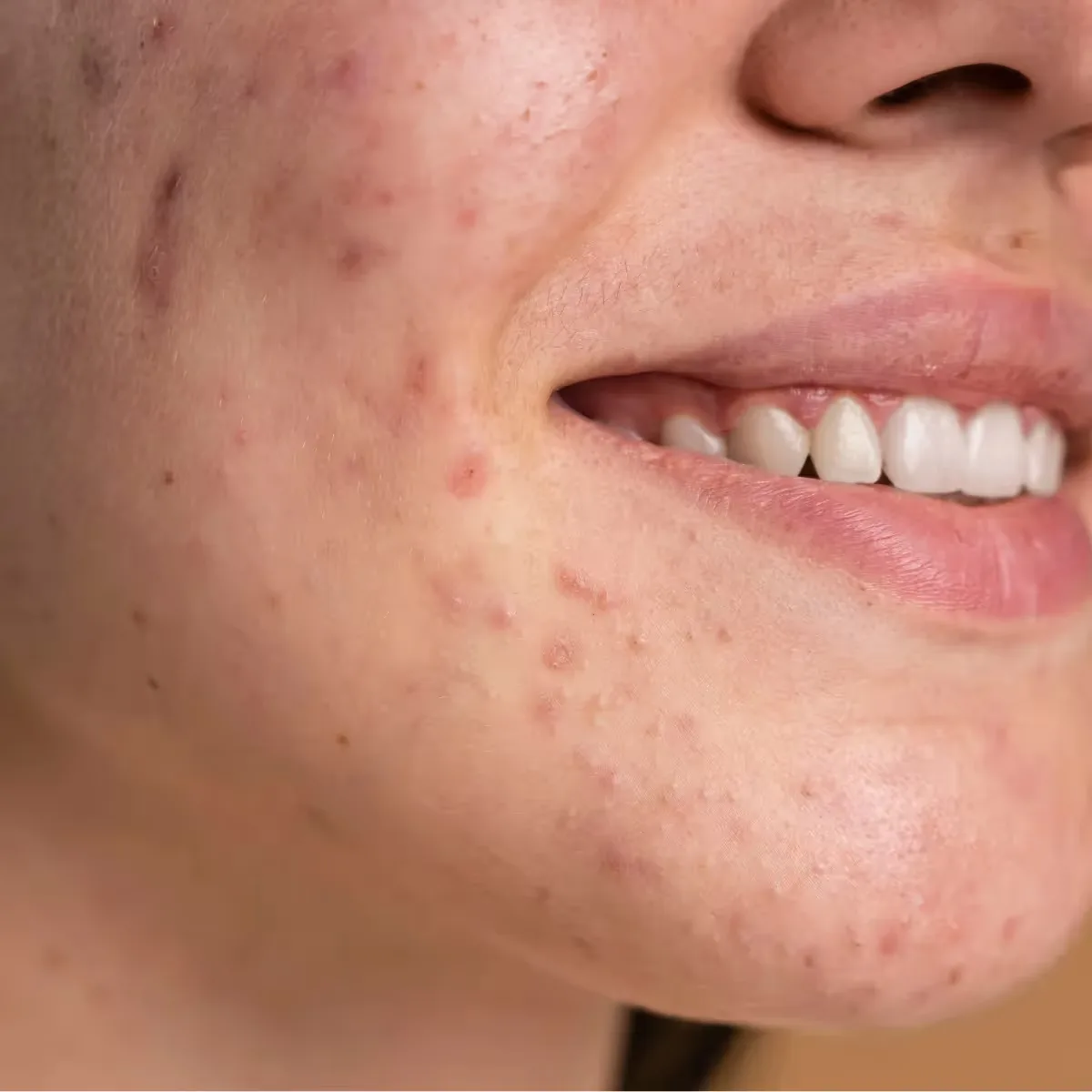 Featured image: 10 Home Remedies for Pimples