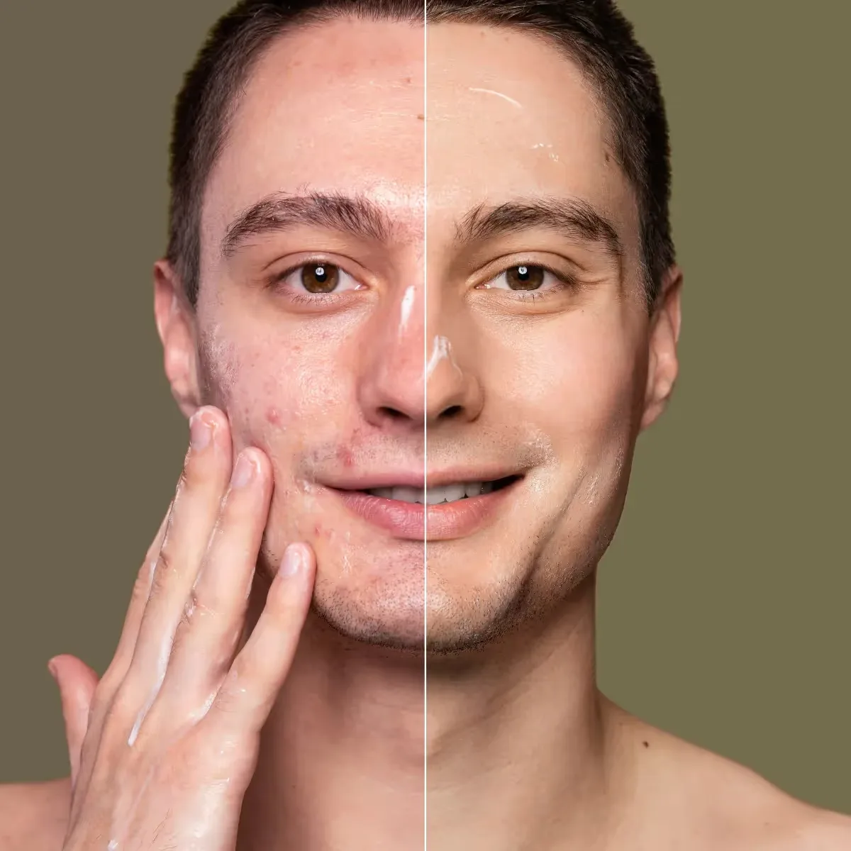 Featured image: 10 Simple Home Remedies For Acne Scars