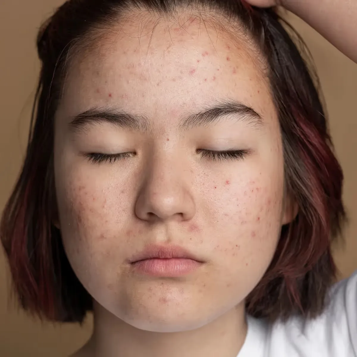 Featured image: 15 Effective and Safe Home Remedies for Acne