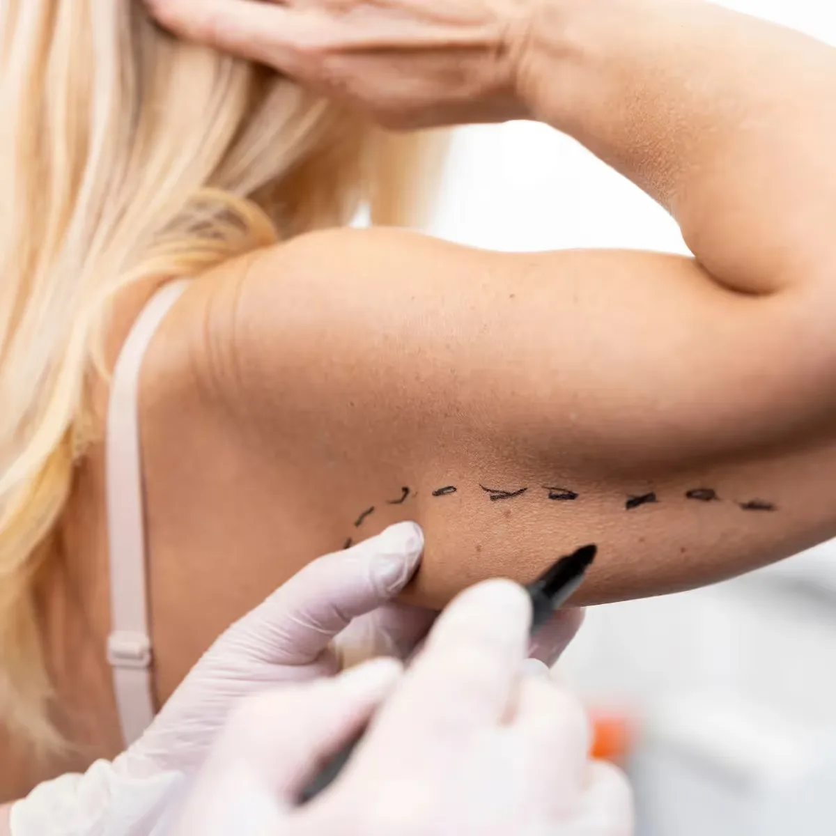 Featured image: 8 Natural Remedies for Scar Removal