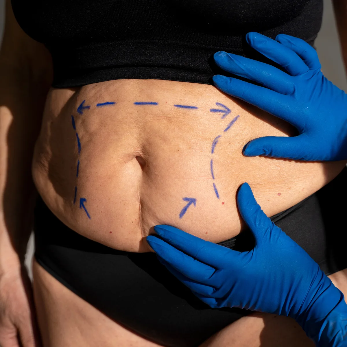 Featured image: Best Treatment for Post-Pregnancy Stretch marks