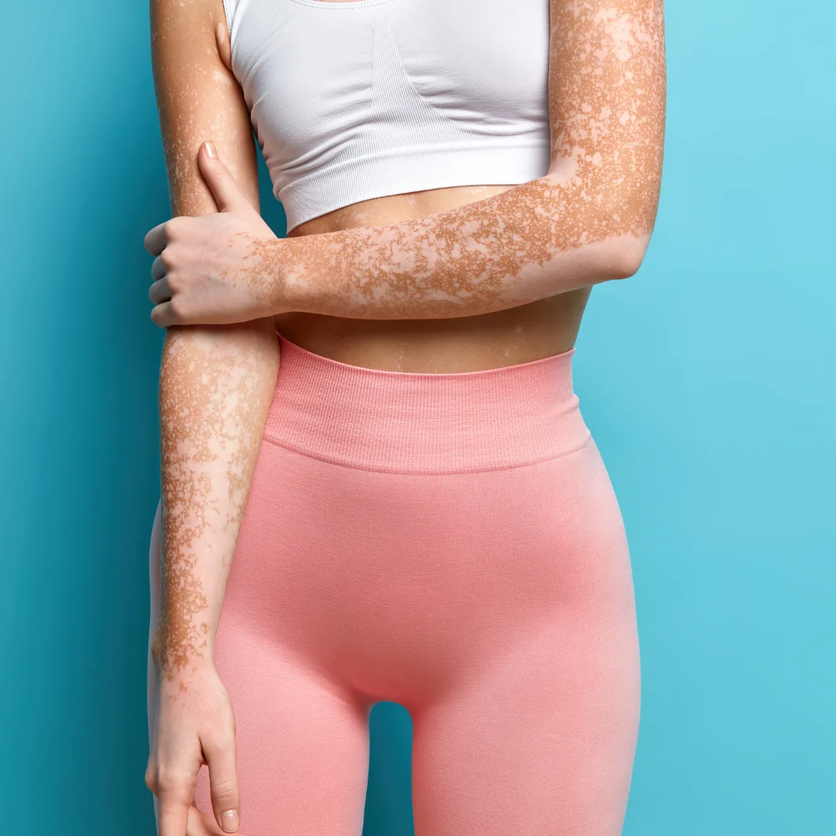 Featured image: Can I Do Laser Hair Removal If I Have Vitiligo?