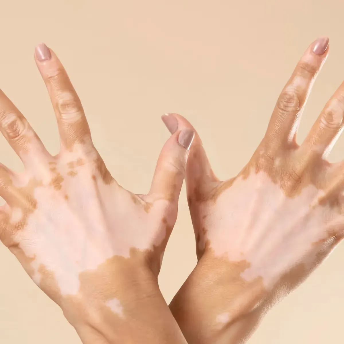 Featured image: How Can I Restore My Vitiligo Pigmentation?