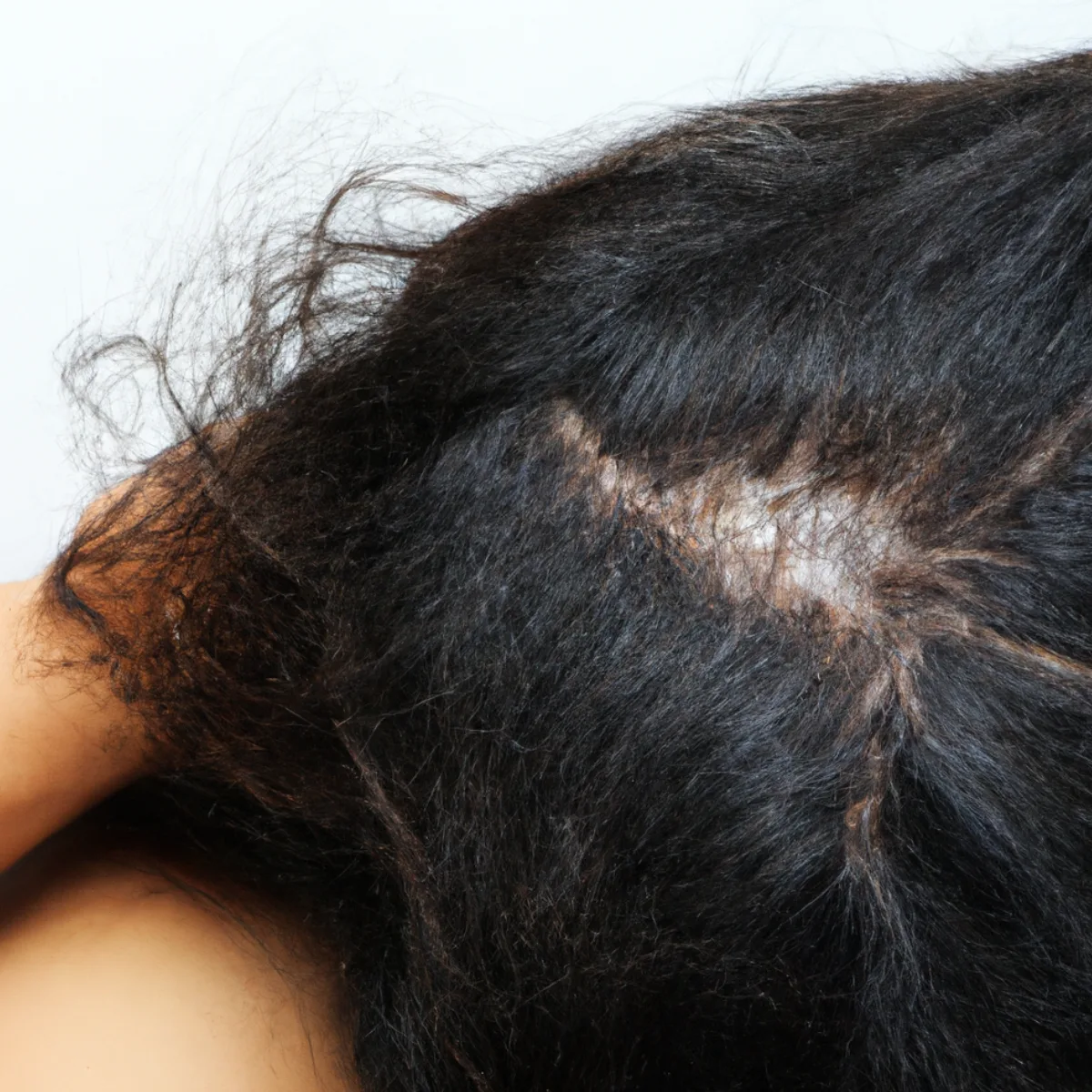 Featured image: How Does Dandruff Lead To Hair Fall?